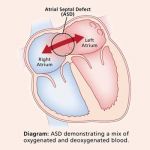 Hole in the Heart (ASD/VSD)
