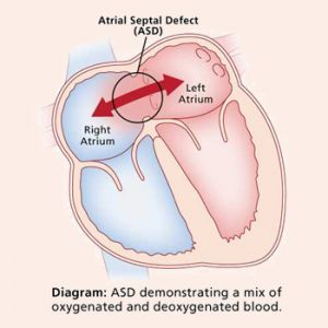 HOLE IN THE HEART (ASD VSD)
