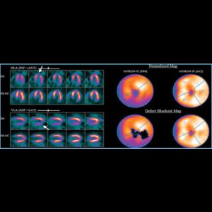RADIONUCLIDE TEST (STRESS THALLIUM)