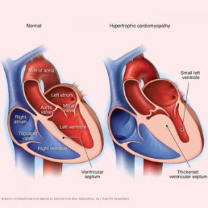 CARDIOMYOPATHY