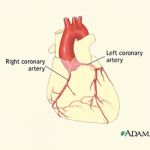 Angiogram (Coronary angiogram)