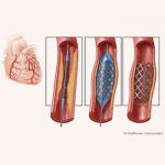 Angioplasty (stent insertion)