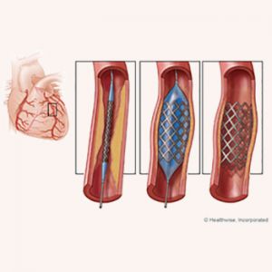 Angioplasty img1