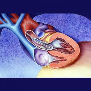 BALLOON AORTIC VALVULOPLASTY (BAV)
