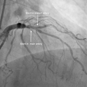 BIFURCATION STENTING img2