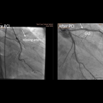 CHRONIC TOTAL OCCLUSION (CTO) ANGIOPLASTY