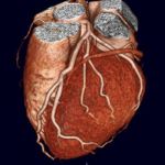 CT coronary angiogram (64/128 sliced)