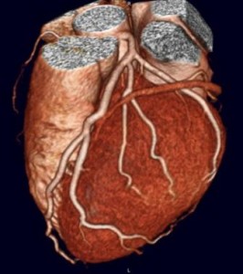 CT coronary angio