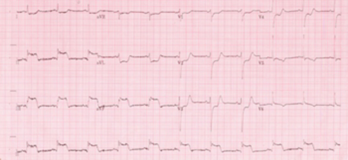 ECG