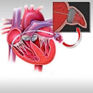 LEFT ATRIAL APPENDAGE (LAA) CLOSURE
