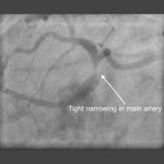 Left main stem (LMS) stenting