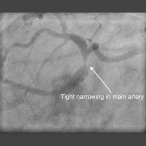 LEFT MAIN STEM (LMS) STENTING img1
