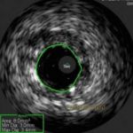 IVUS (Intravascular Ultrasound)