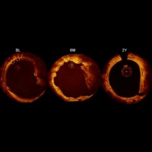 OCT (OPTICAL COHERENCE TOMOGRAPHY)