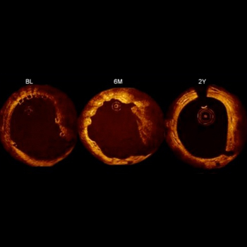 OCT (OPTICAL COHERENCE TOMOGRAPHY)