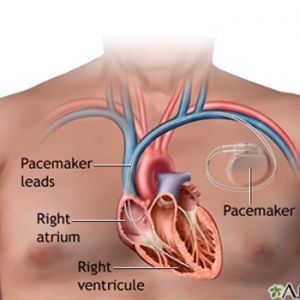 PACEMAKER