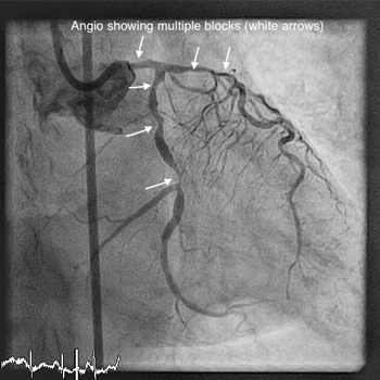 ROTABLATION (ROTATIONAL ATHERECTOMY) img1