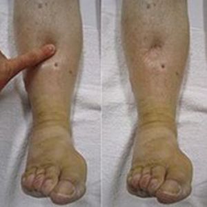 SWELLING OF FEET