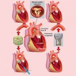 Transcatheter Aortic Valve Implantation (TAVI) or (TAVR)