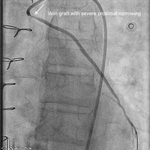 VEIN GRAFT (SVG) STENTING img1