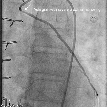 VEIN GRAFT (SVG) STENTING img1
