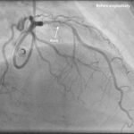 Three Vessel Angioplasty Via Wrist
