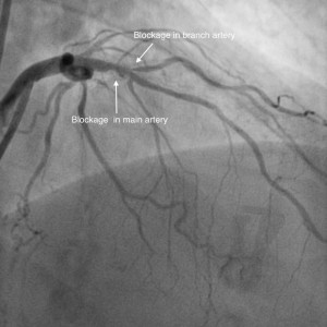 Bifurcation_pre PCI