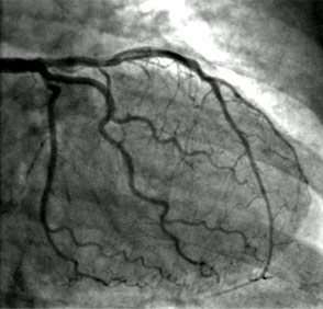 angiogram_2