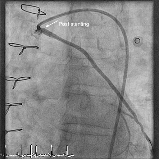 post PCI_annotate