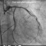 Mending The Heart By Drilling