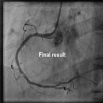 Rescue Angioplasty