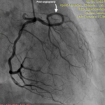 Single Coronary Art – anomalous Cx PCI