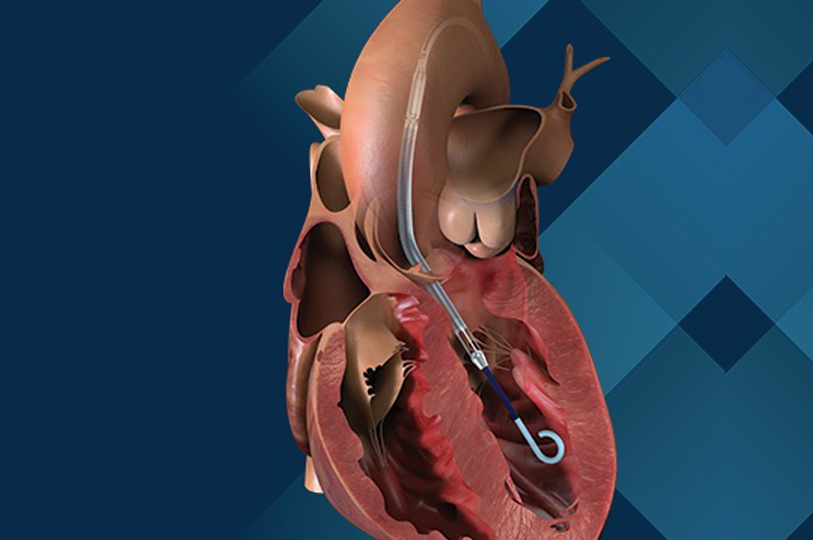 impella